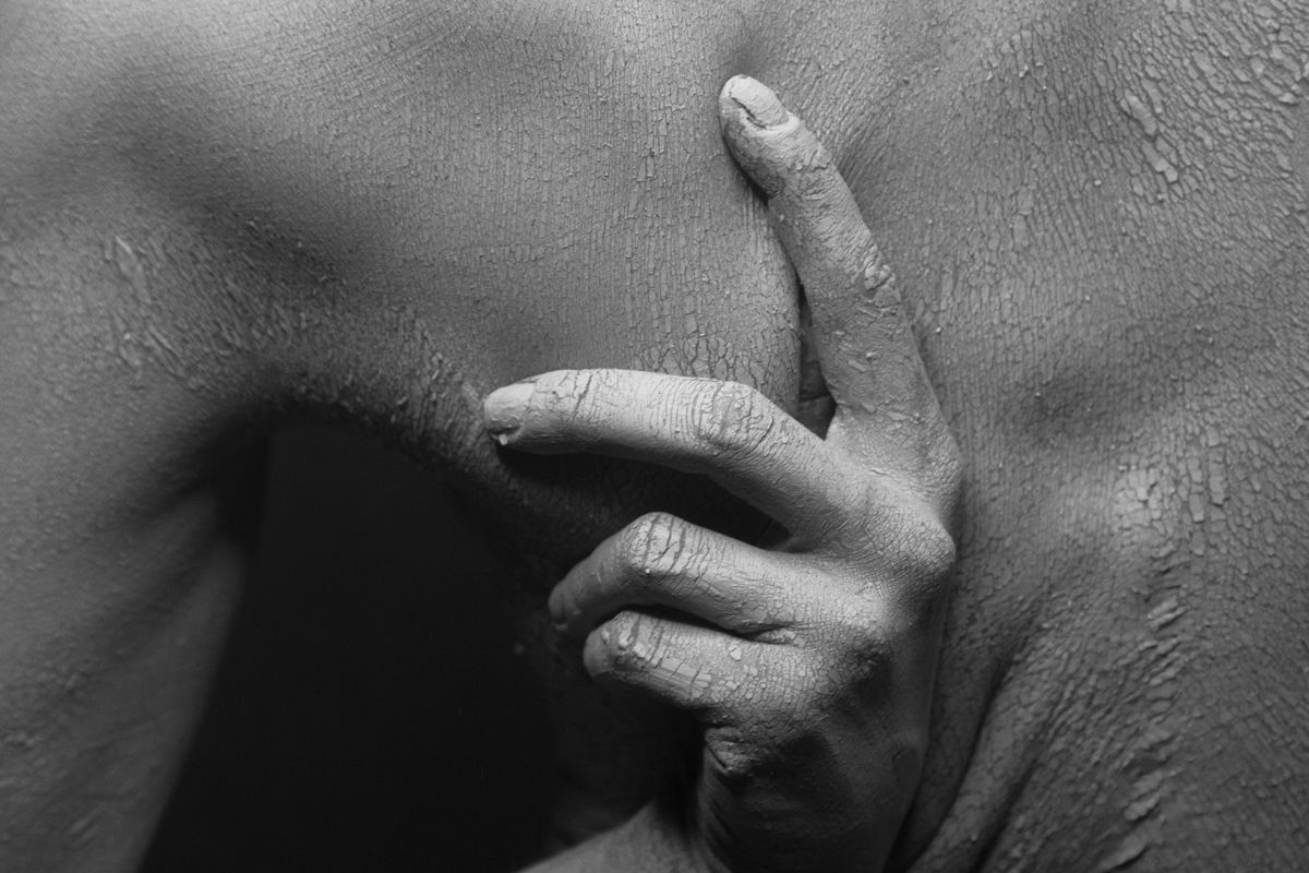 ผื่นภูมิแพ้ผิวหนัง (Eczema) คันเรื้อรังที่ดูแลได้